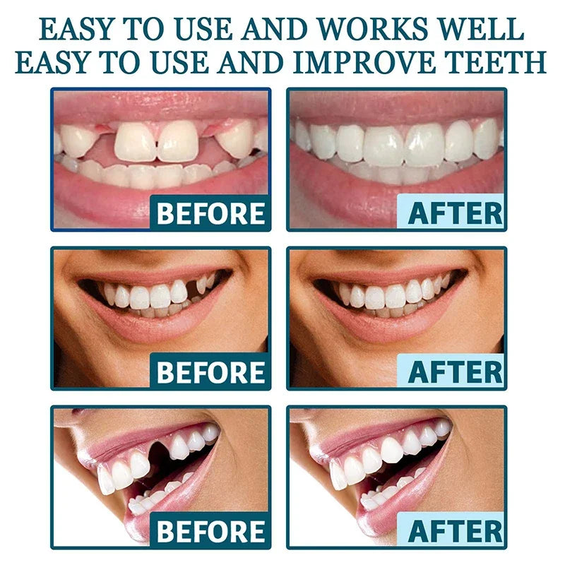NewSmile - Snap-On Dentures™