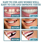 NewSmile - Snap-On Dentures™