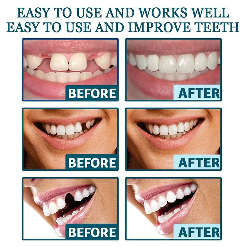 NewSmile - Snap-On Dentures™