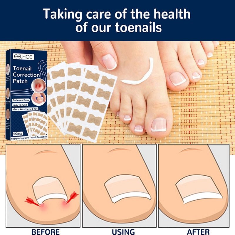 NailFixer™ - Toenail Paronychia Corrector (50 Pcs ) - Cartnoova
