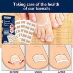 NailFixer™ - Toenail Paronychia Corrector (50 Pcs ) - Cartnoova