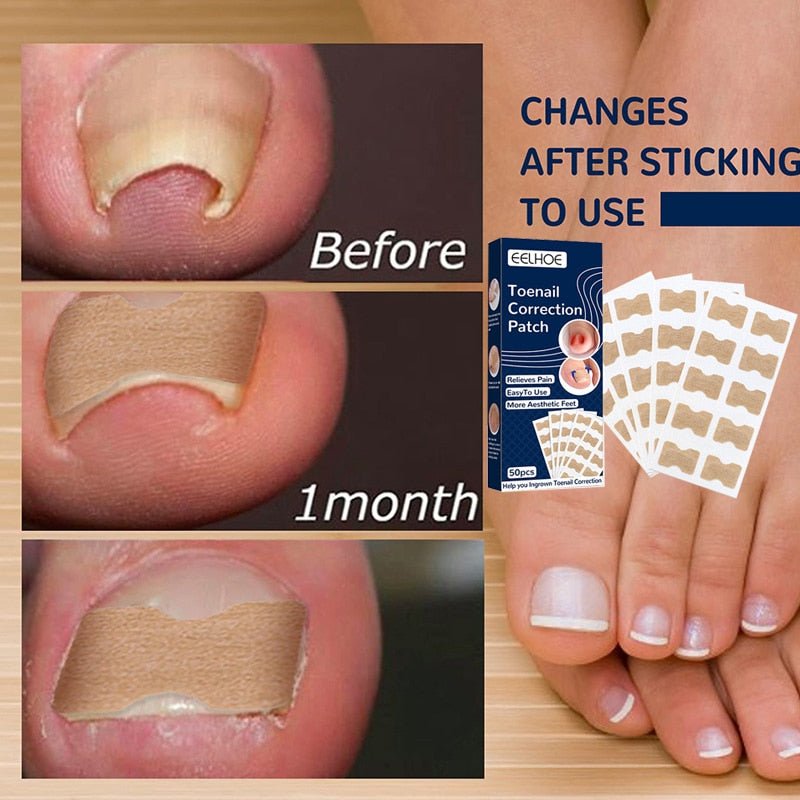 NailFixer™ - Toenail Paronychia Corrector (50 Pcs ) - Cartnoova