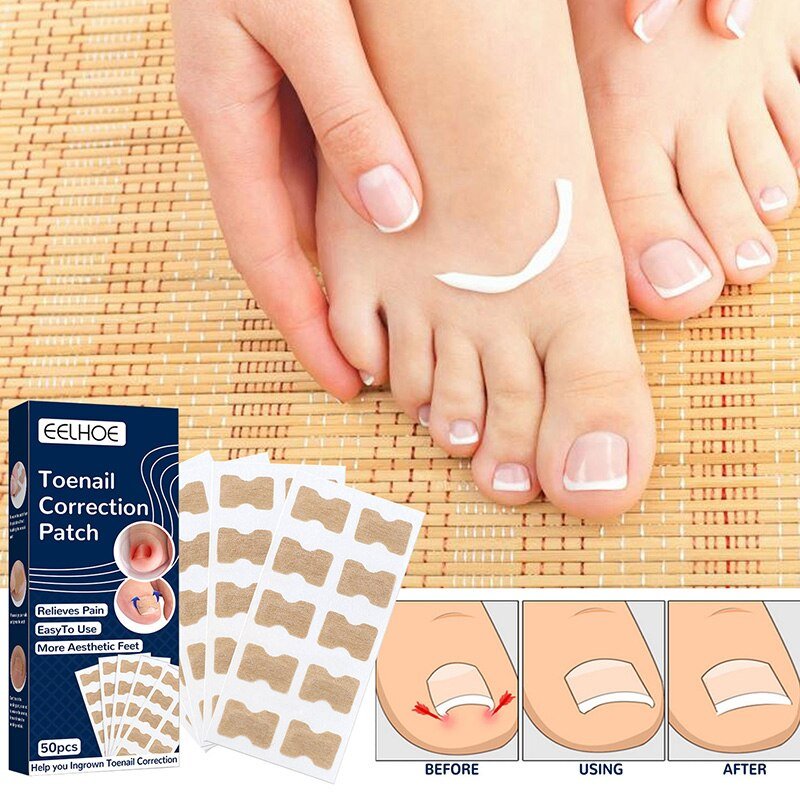 NailFixer™ - Toenail Paronychia Corrector (50 Pcs ) - Cartnoova