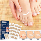 NailFixer™ - Toenail Paronychia Corrector (50 Pcs ) - Cartnoova