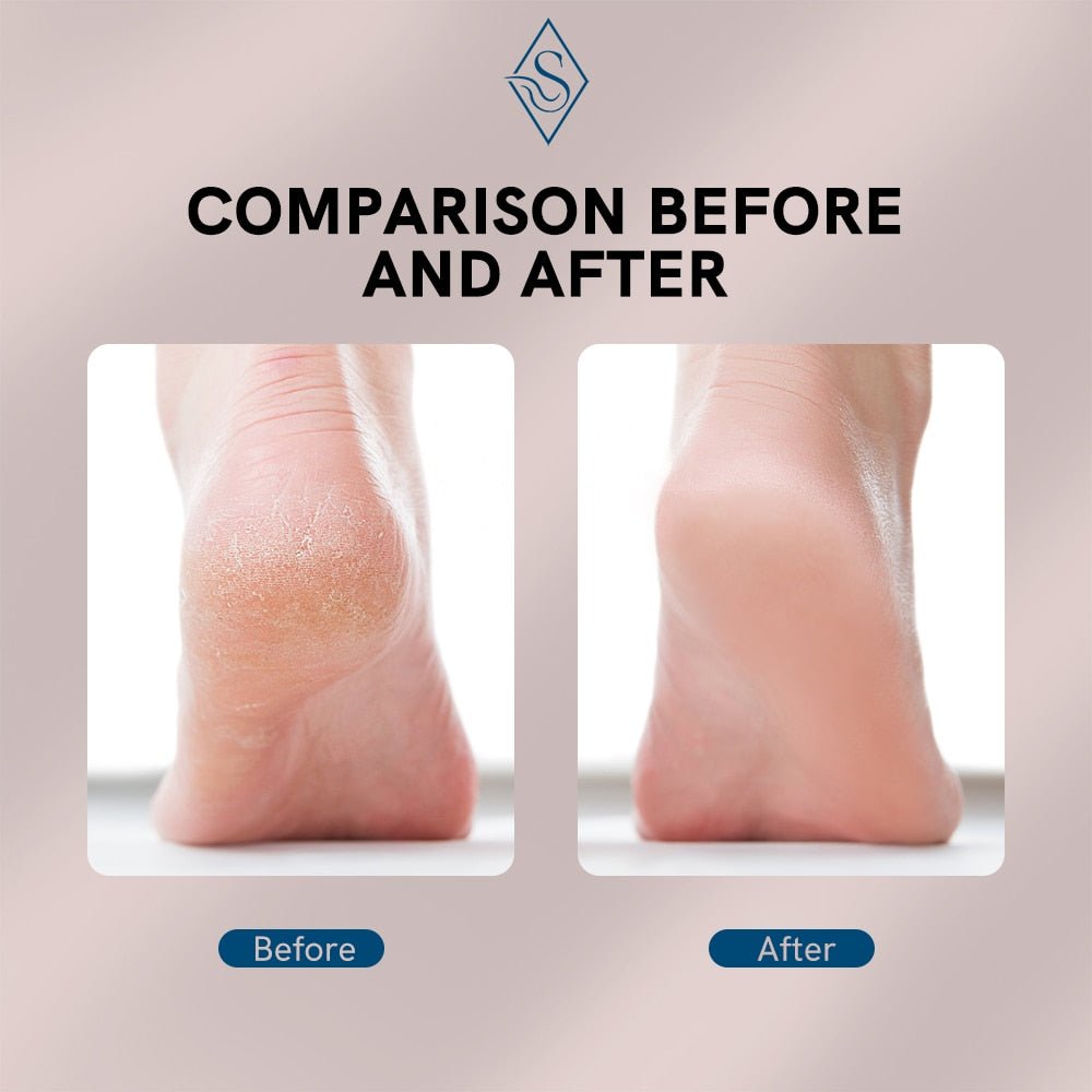 Rechargeable Electric Foot Callus Remover Pedicure Machine - Cartnoova