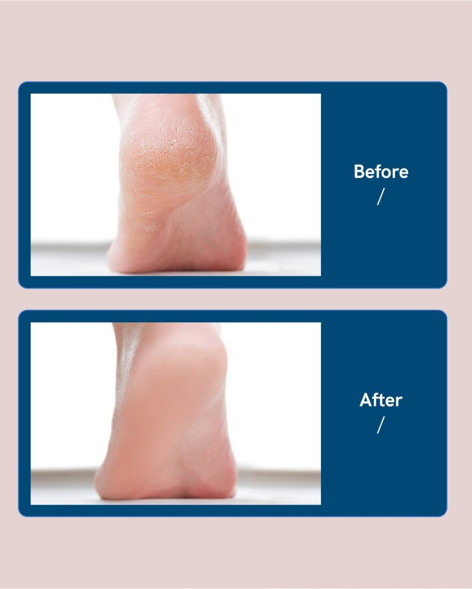 Rechargeable Electric Foot Callus Remover Pedicure Machine - Cartnoova